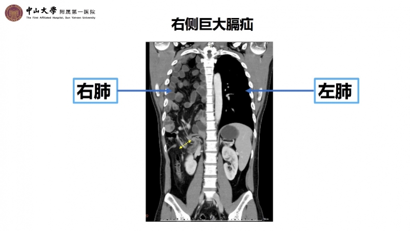 巨大膈疝2.jpg