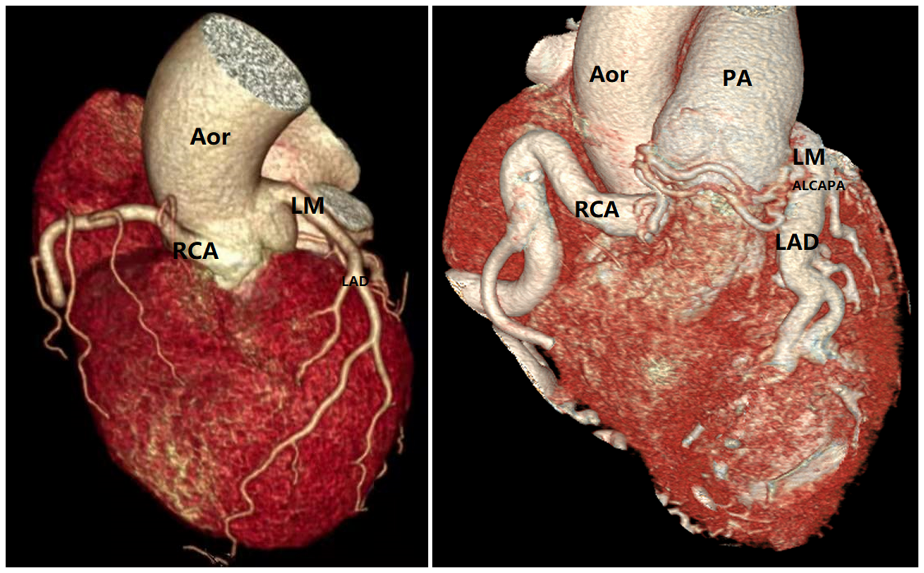 广州医生手绘数张素描，独创术式治好心脏病