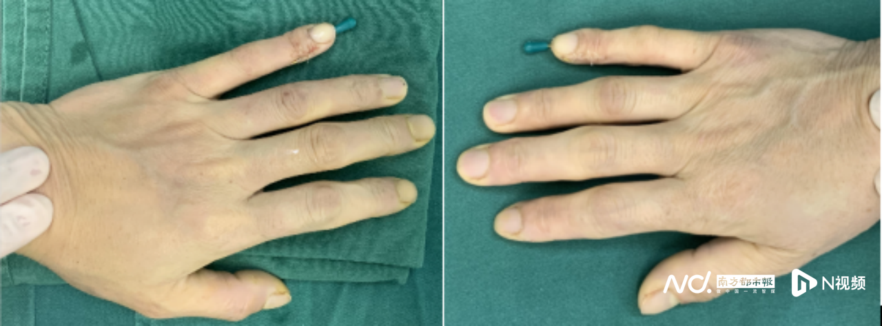 副本媒体-女子双手小指末端天生“驼背”，精巧V截骨手术矫正1160.png
